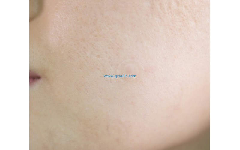 化妝品護膚品優質祛痘抗痘消炎活性成分的功效與作用